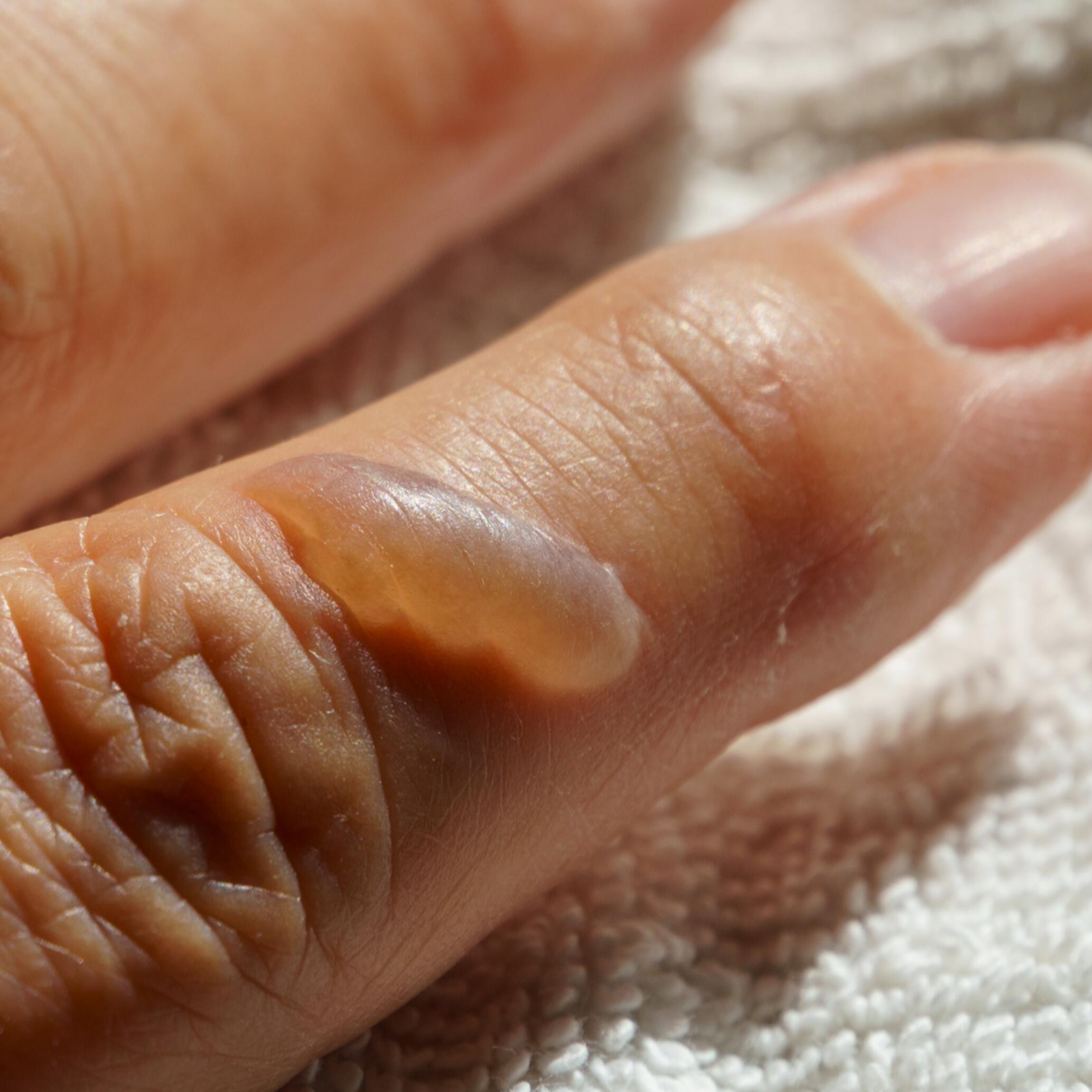 Toisen asteen palovamma